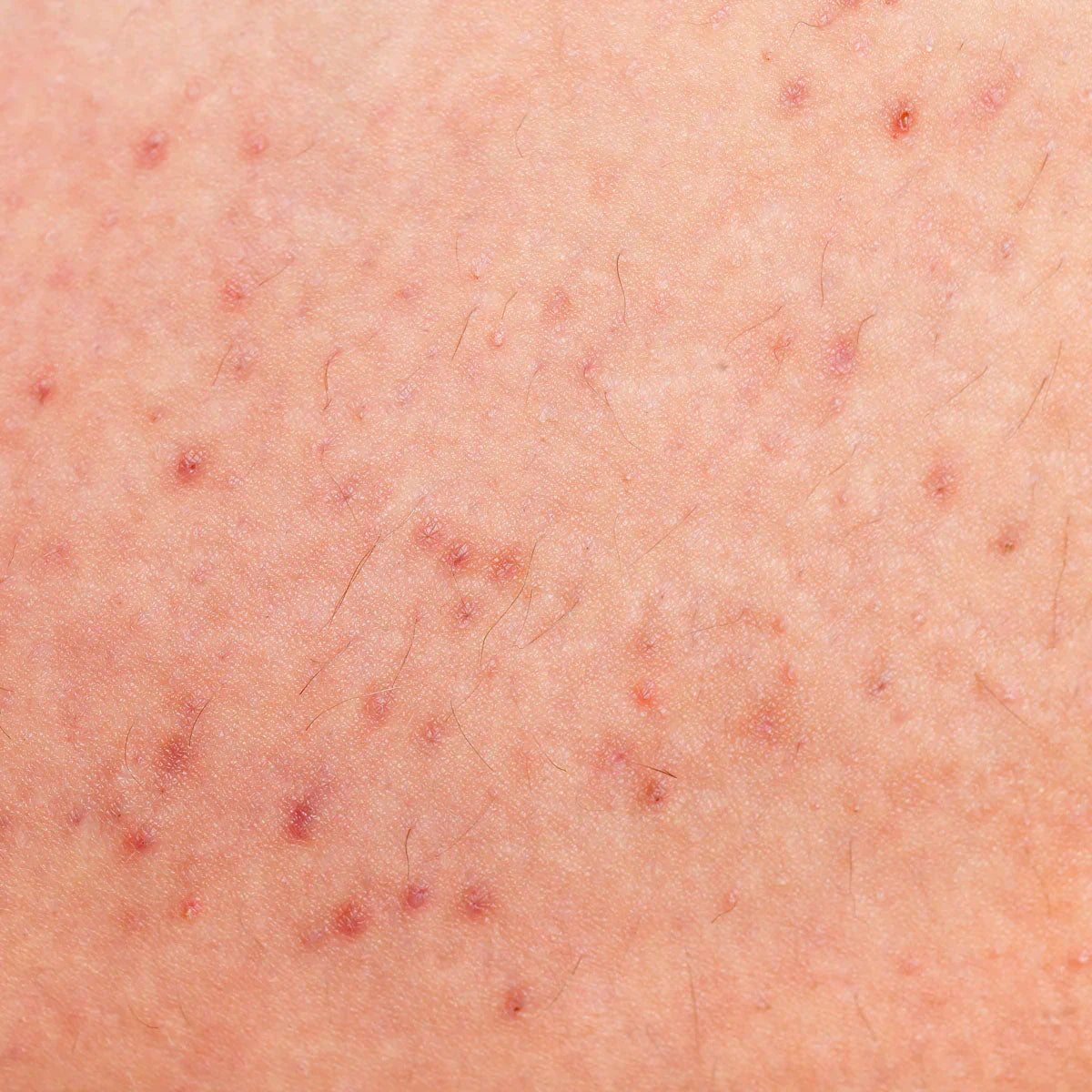 Tıraş bıçağı darbelerinden kaçının - işte nasıl yapılacağı