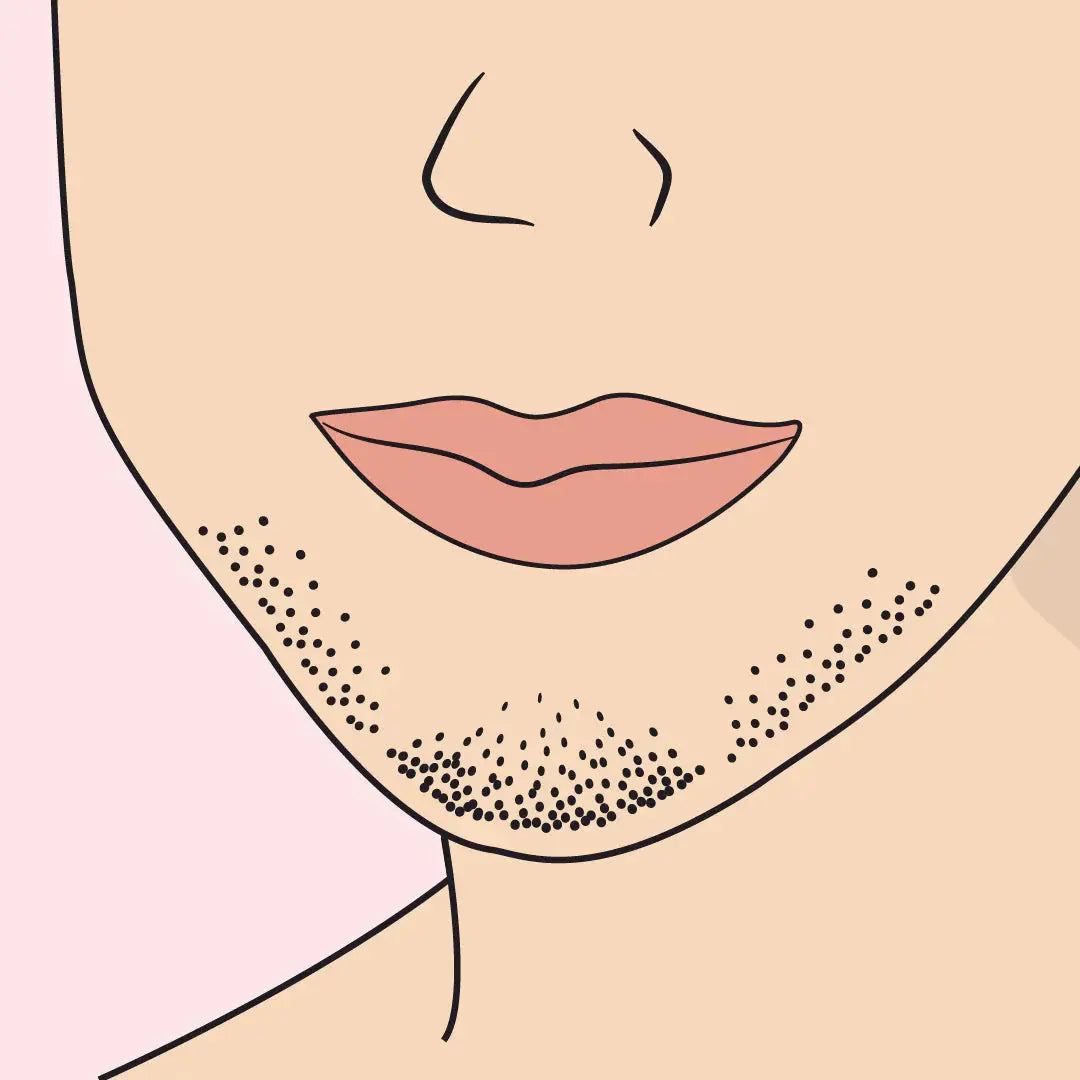 PCOS & Hair Growth: What Really Works? shinie