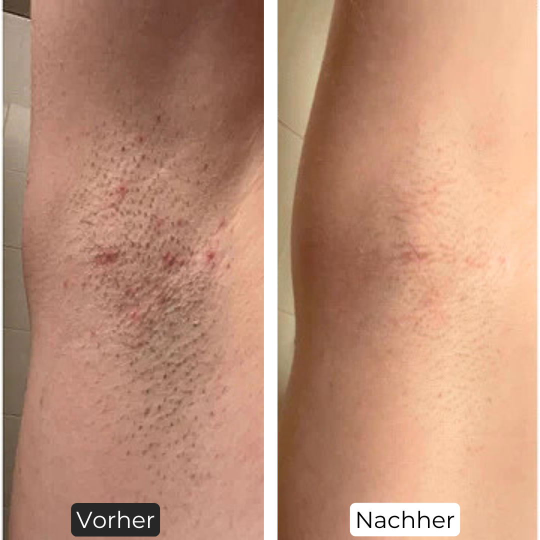 Premium Haarfrei Bundle