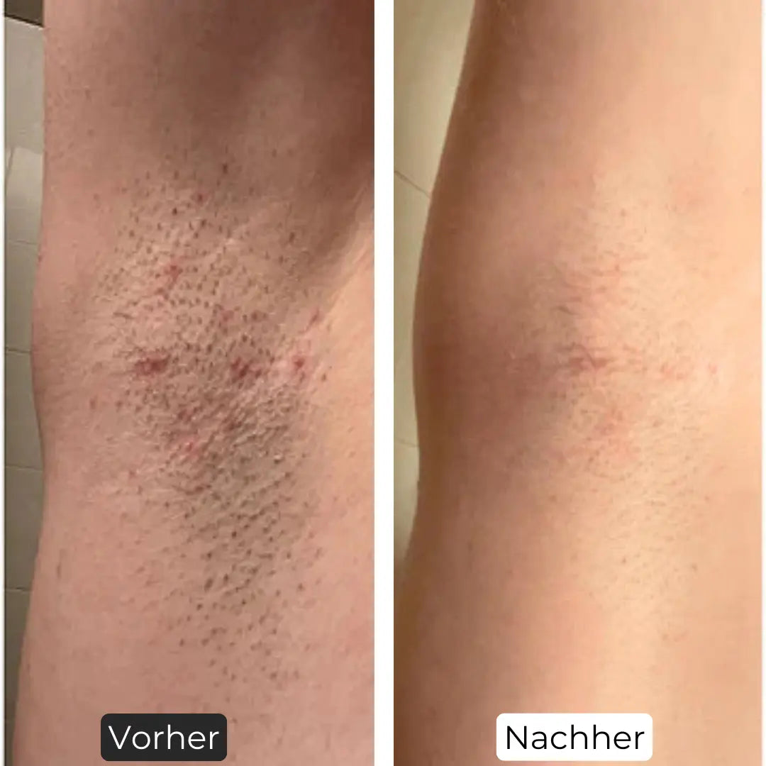 Premium Haarfrei Bundle Shinie