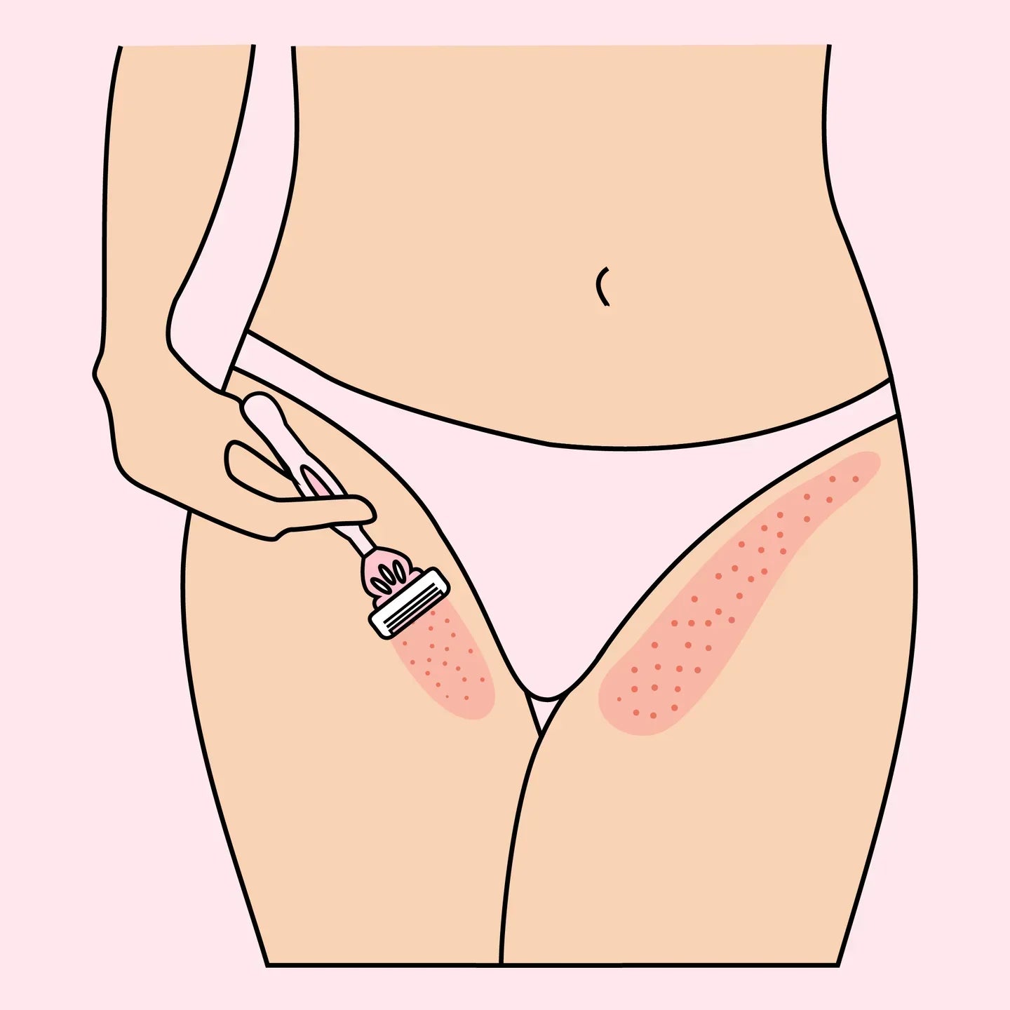 Treating razor burn in the genital area - here's how