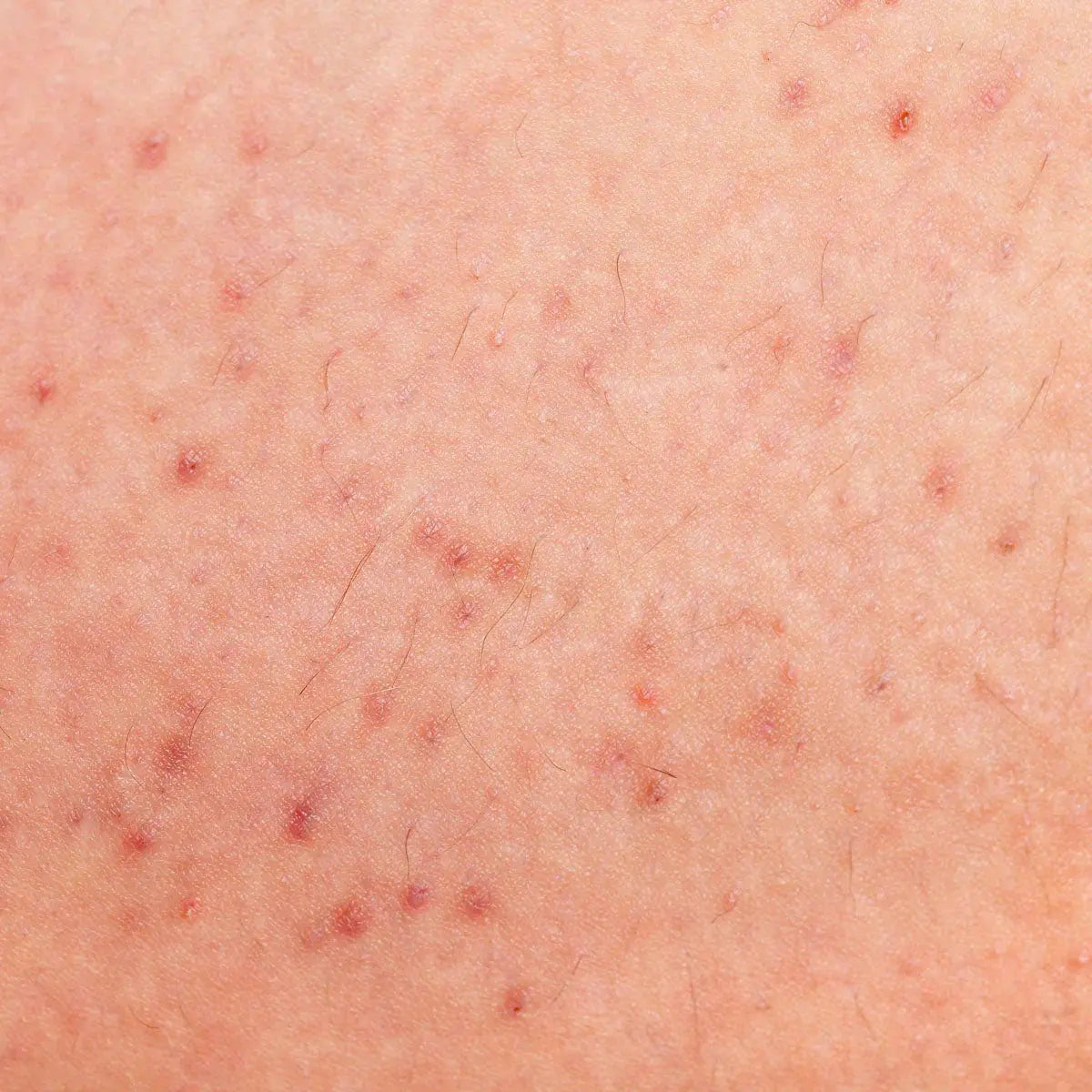 Jak uniknąć krostek po goleniu – oto jak to zrobić, shinie